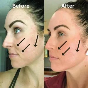 Facelift or Neck lift