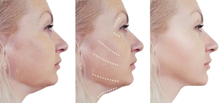 Facelift or Neck lift