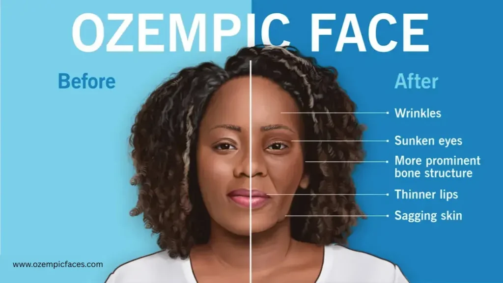 rid ozempic faces
